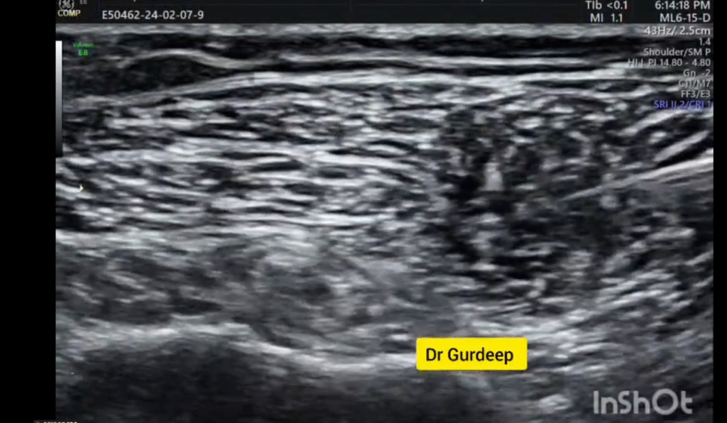 MSk Interventions Biceps Injection