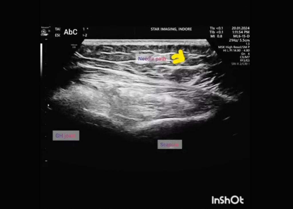 MSK Posterior Glenohumeral Joint injection