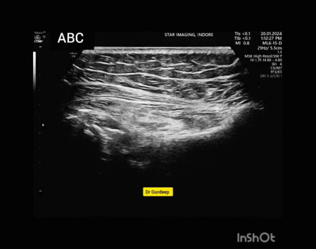 Posteriro GlenoHumeral Joint Injection